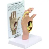 3B Scientific Modell einer Hand mit Osteoarthritis