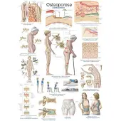 Erler Zimmer Lehrtafel Osteoporose, 70x100cm