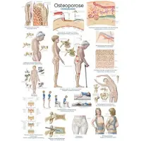 Erler Zimmer Lehrtafel Osteoporose, 70x100cm